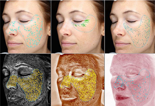 Hydrafacial-Visia Hydrafacial-Visia