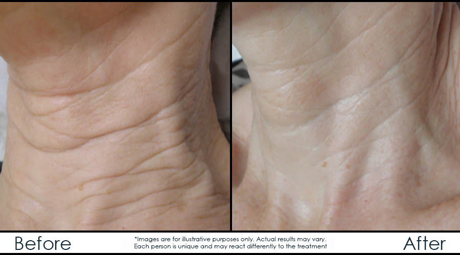 before-after-4-rf-en before-after-4-rf-en