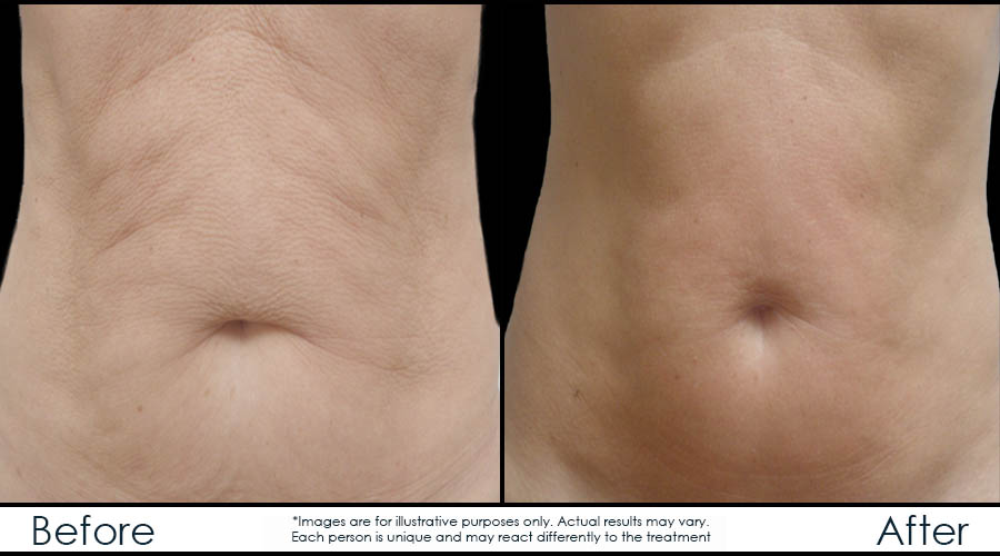 before-after-7-rf-en before-after-7-rf-en