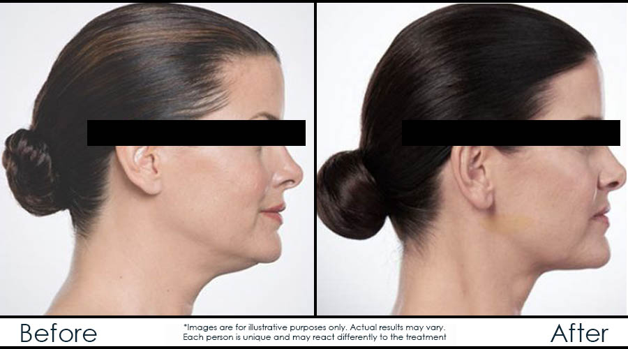 before-after-en-belkyra before-after-en-belkyra