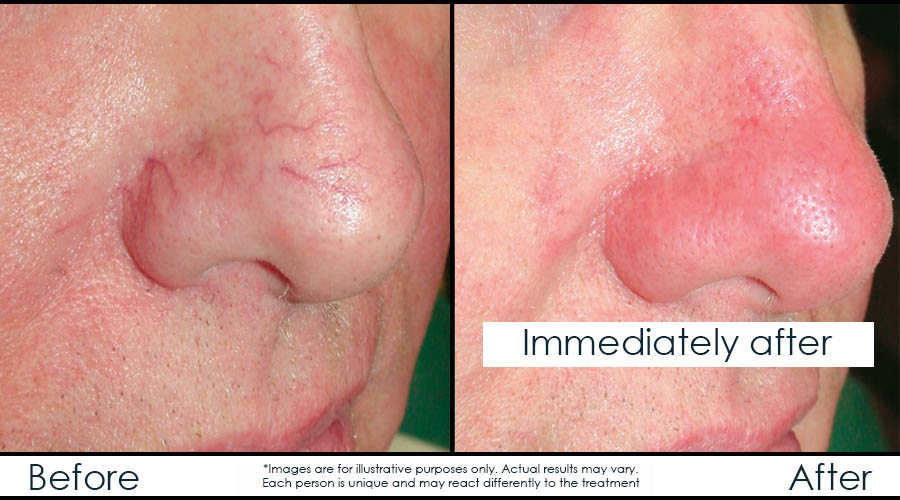 before-after-laser-veins-en before-after-laser-veins-en