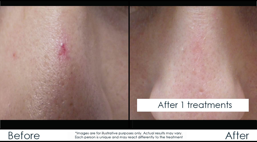 before-after-laser-veins-en4 before-after-laser-veins-en4