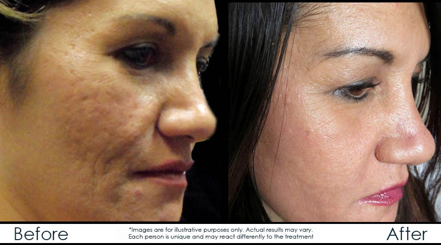 Microneedling Microneedling