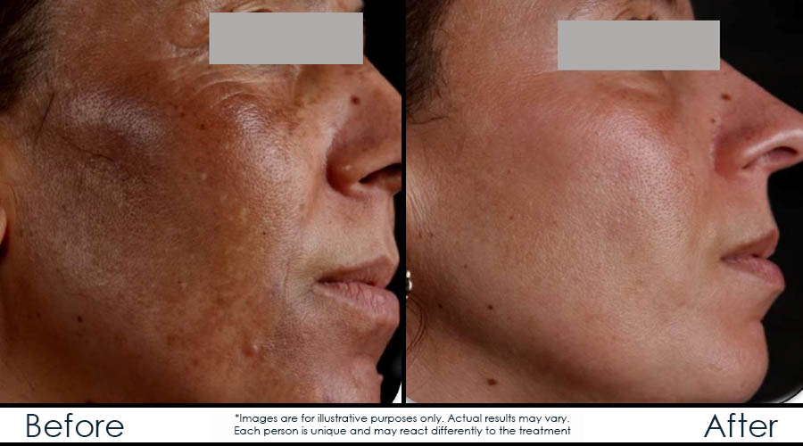 peeling chimique peeling chimique
