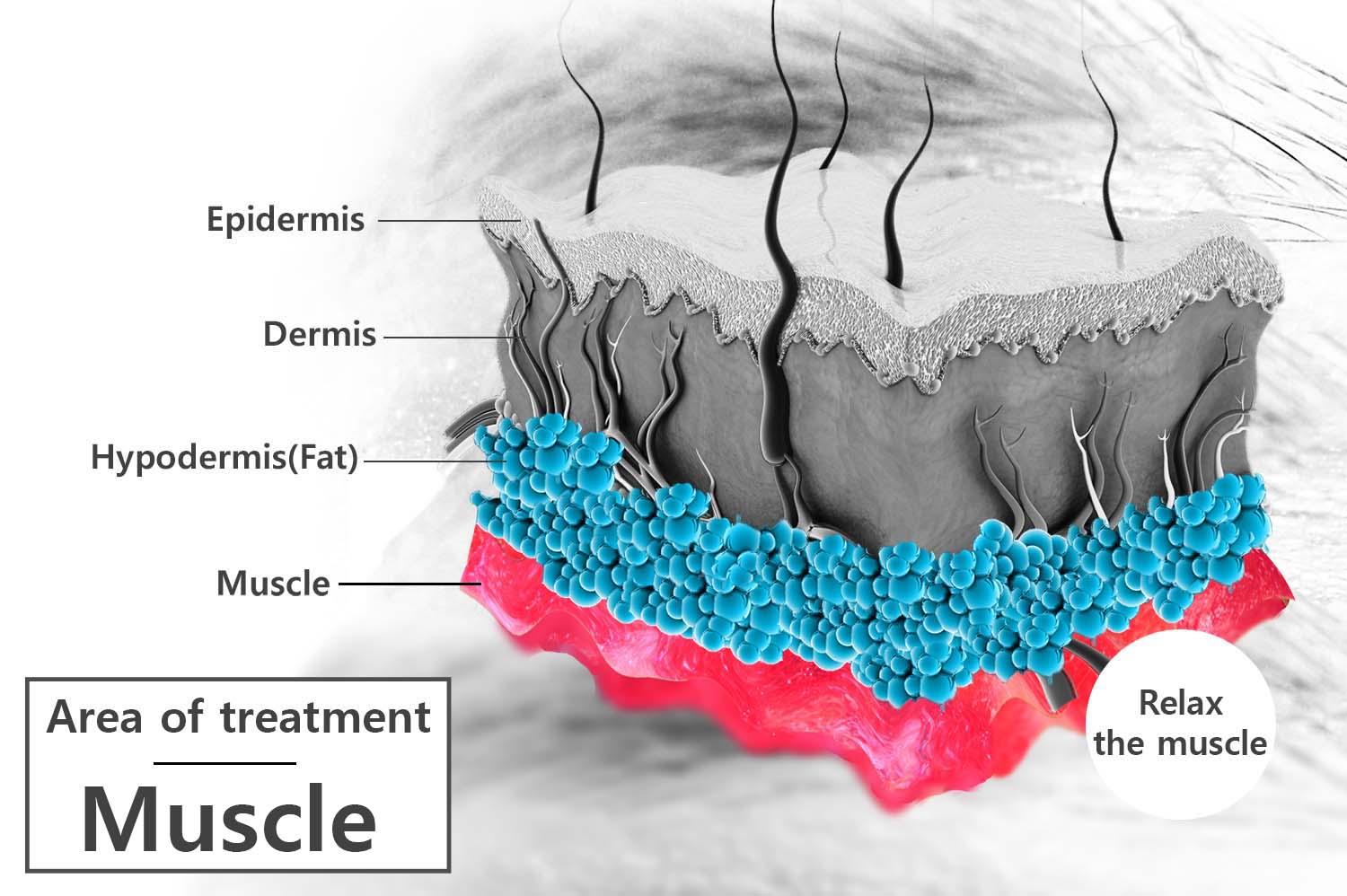 Botox-muscle-treatment-area