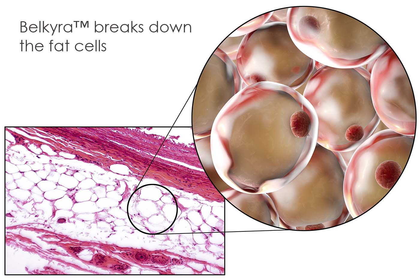 chin reduction fat cell chin reduction fat cell