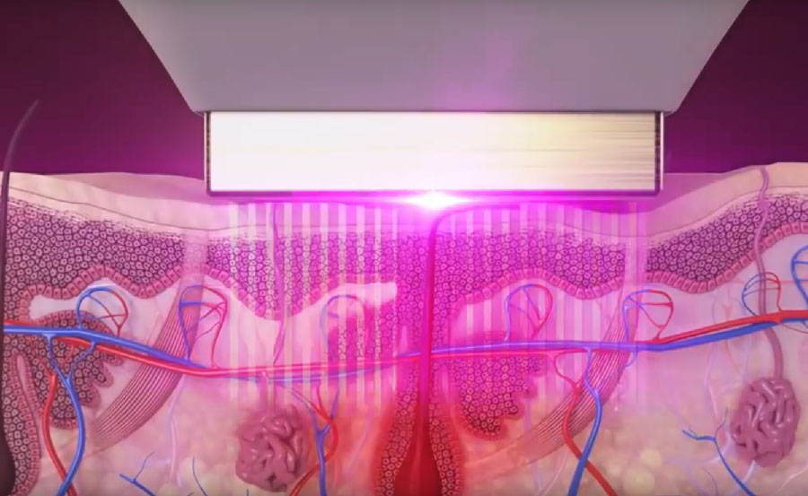 laser-hair removal-venus velocity laser-hair removal-venus velocity