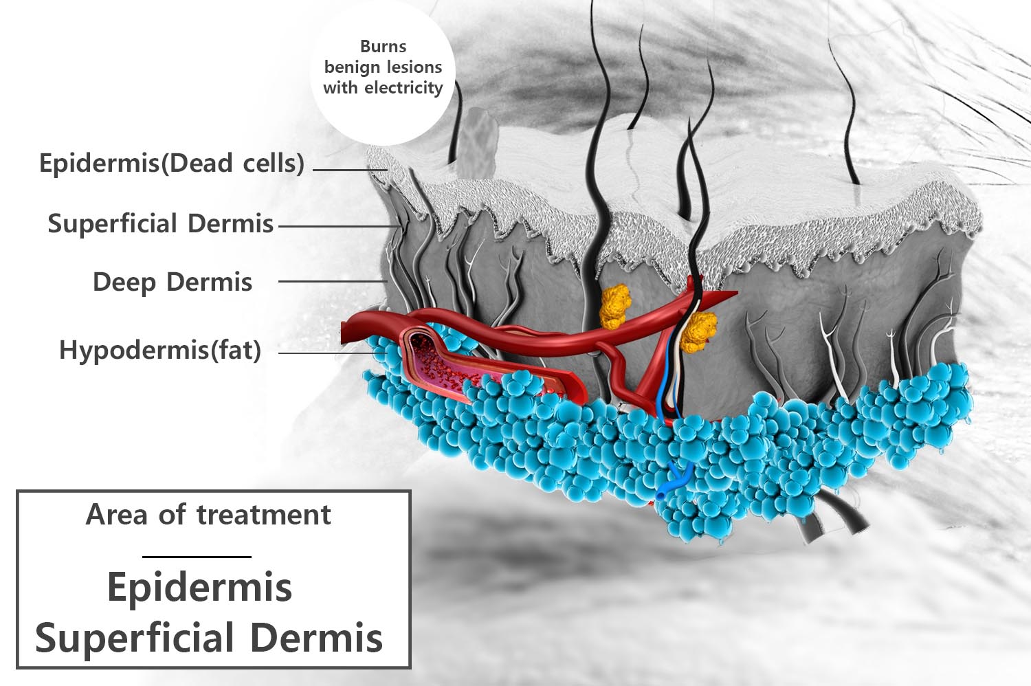 benign lesion by thermocoagulation benign lesion by thermocoagulation