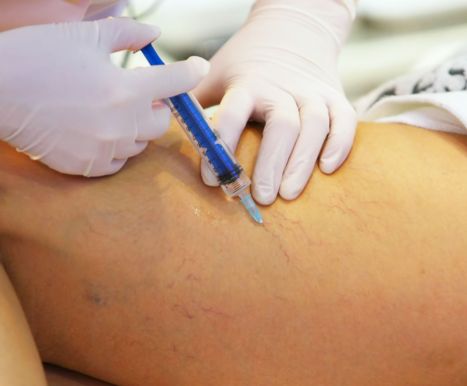 Treatment of varicose veins Treatment of varicose veins