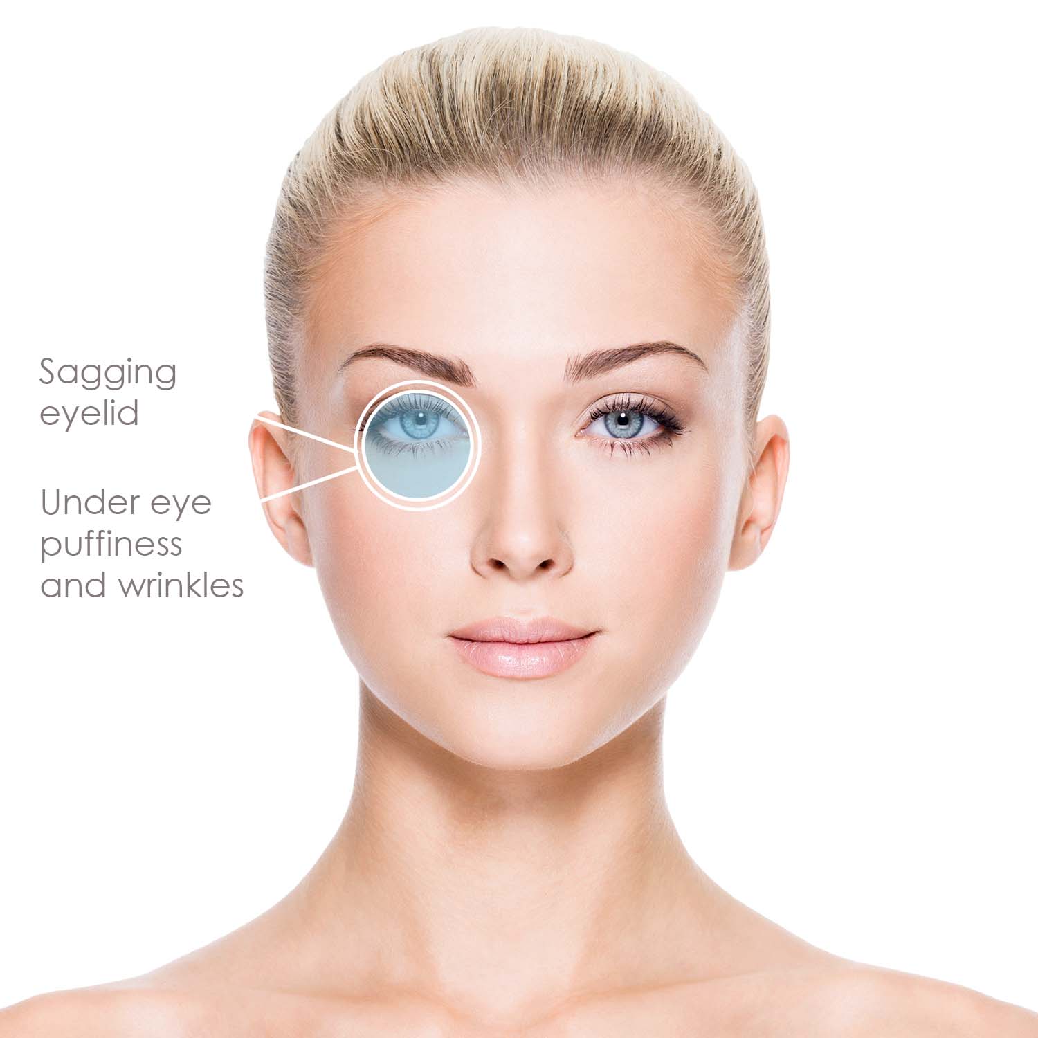 undereye-puffiness-wrinkles-sagging-eyelid undereye-puffiness-wrinkles-sagging-eyelid