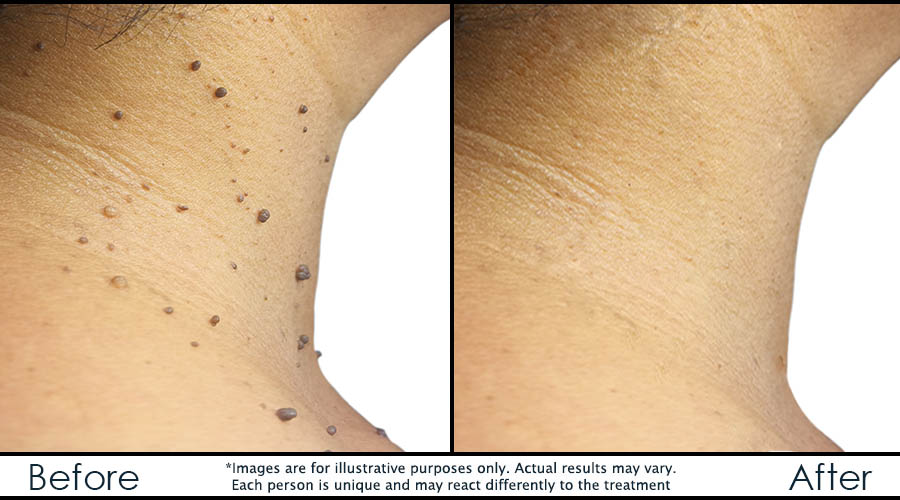 skin tags skin tags