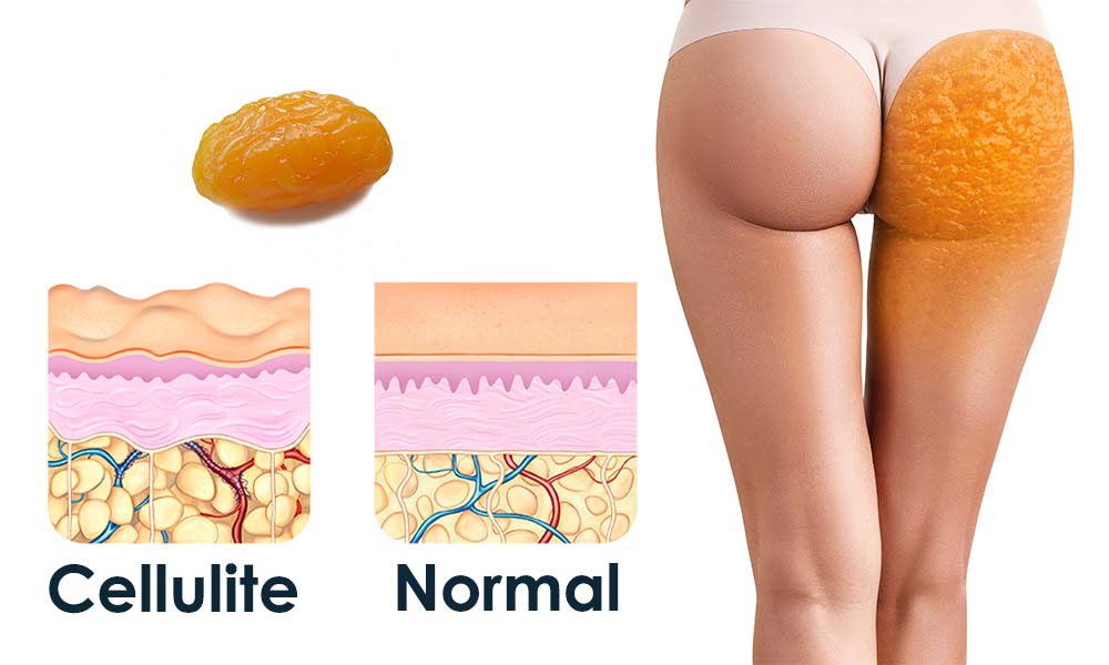 cellulite