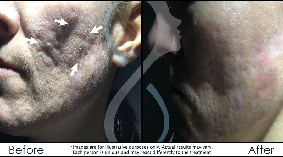 cicatrices-acne-bf-en cicatrices-acne-bf-en