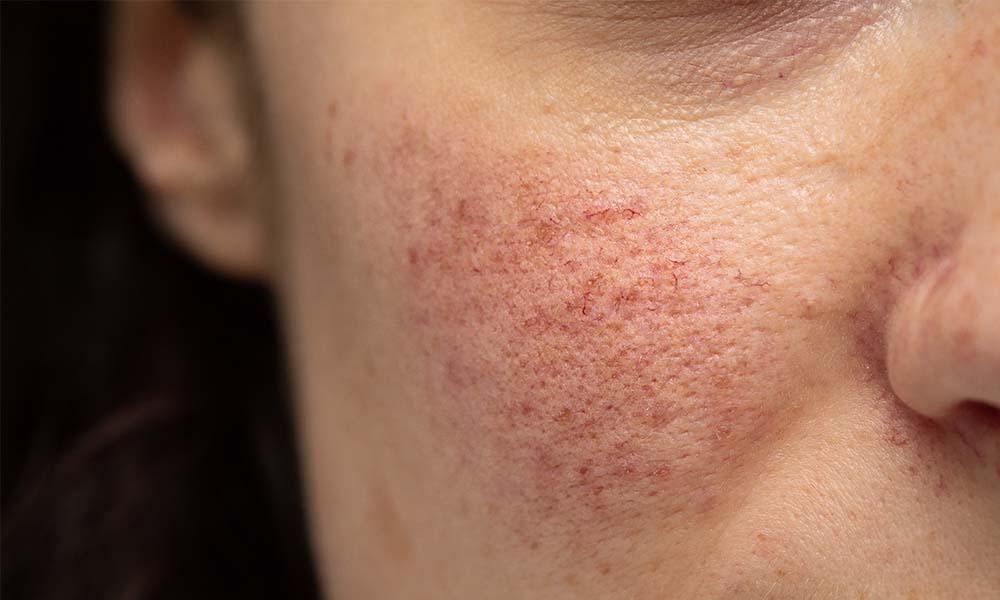 pores-dilatés pores-dilatés