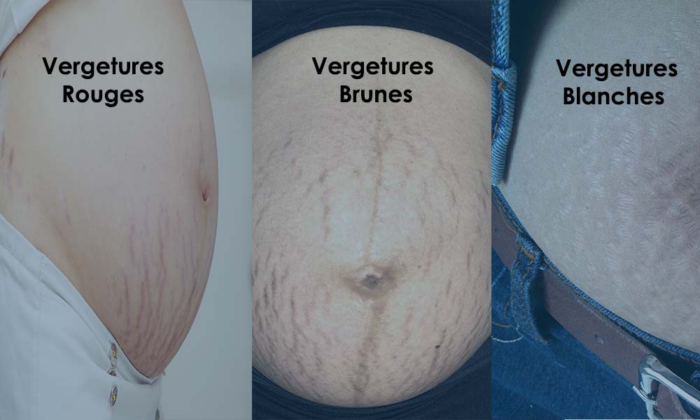 vergetures vergetures