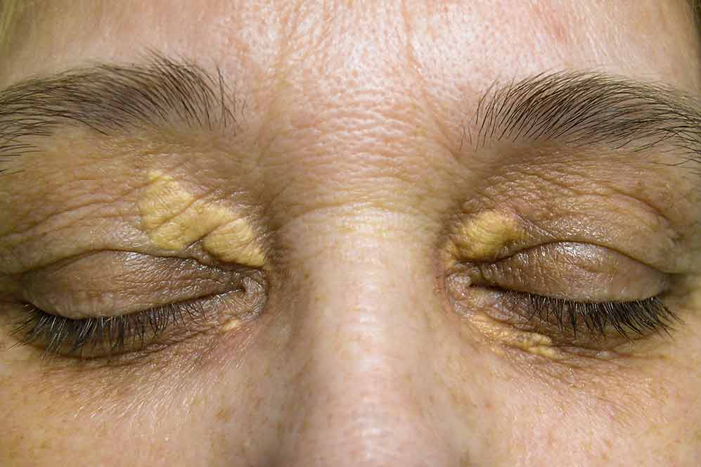 xanthelasma-exemple xanthelasma-exemple