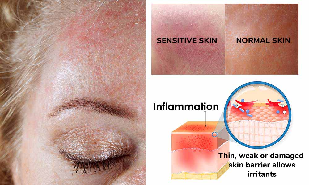 sensitiveskin sensitiveskin